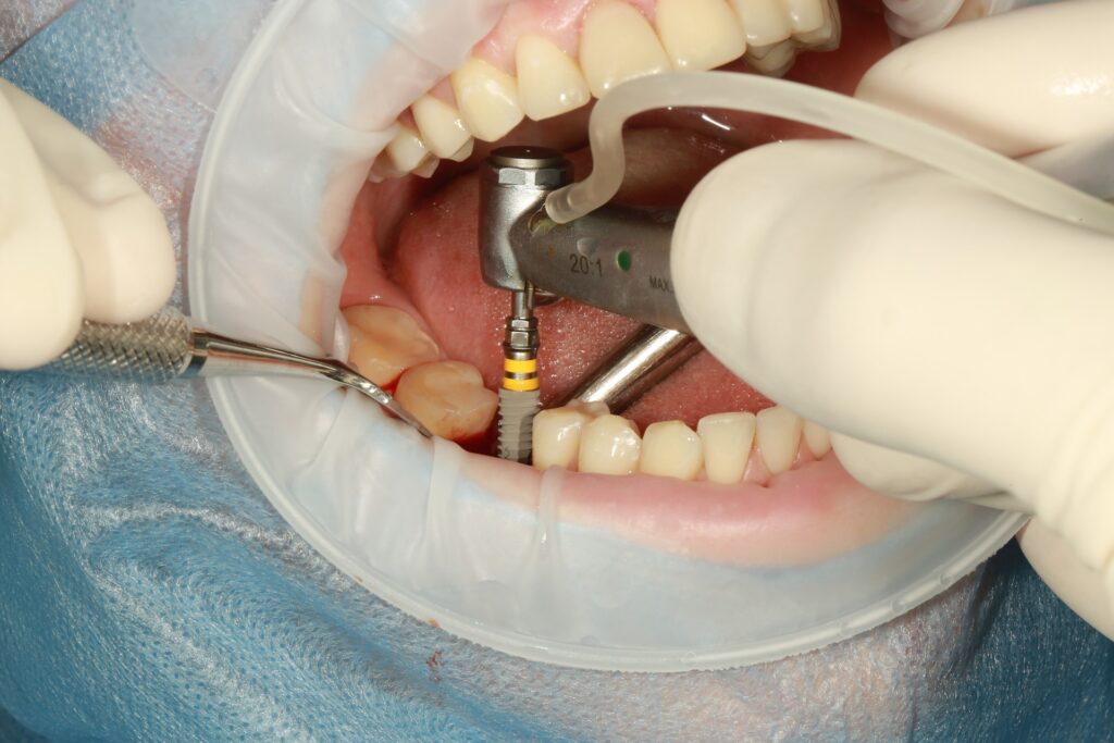 This Is What You Should Pay For Dental Implants