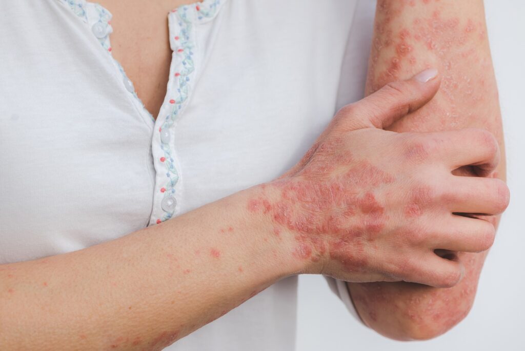 Eczema and Psoriasis: What Are the Differences Between the Two?