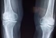 X-ray of knee joints