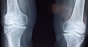 X-ray of knee joints
