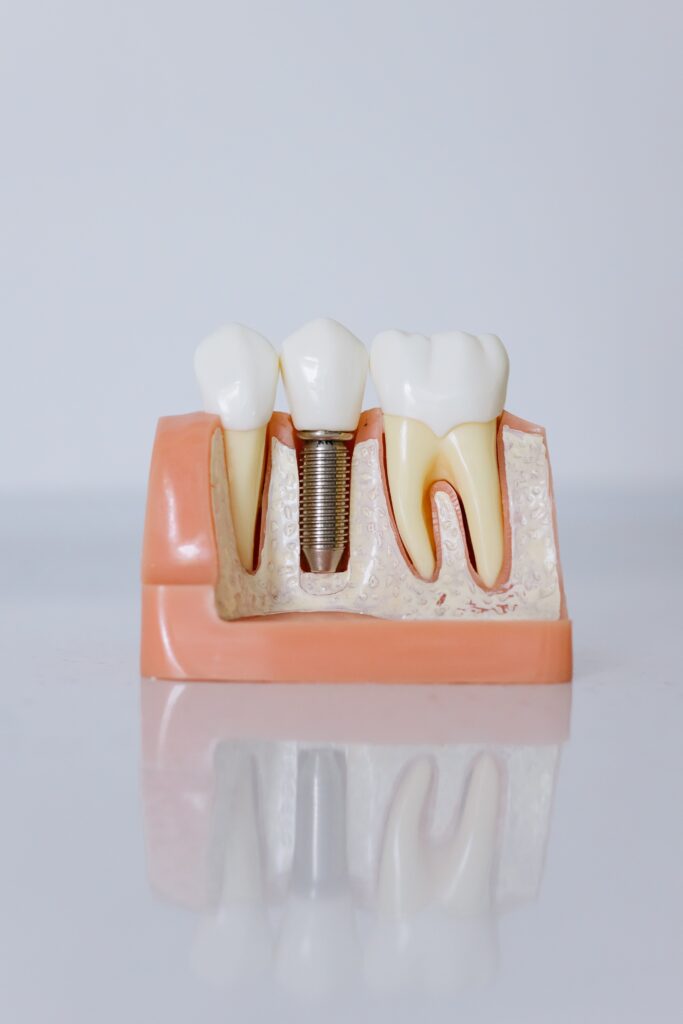 10 Possible Dental Implant Surgery Problems to Monitor